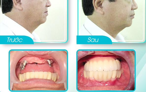 Trước và sau khi trồng răng Implant.