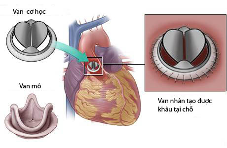 Thay van tim được thực hiện dựa theo mức độ tổn thương van.