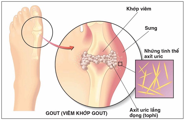 Thừa Axit Uric: Nguyên Nhân, Triệu Chứng và Cách Điều Trị Hiệu Quả