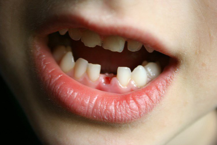 Trẻ sẽ có 2 giai đoạn phát triển răng là mọc răng sữa và răng vĩnh viễn.