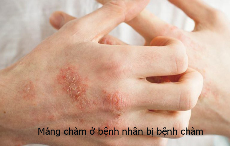 Bác sĩ chuyên khoa Da liễu Đoàn Ngọc Thanh khám sức khỏe về da cho bệnh nhân.