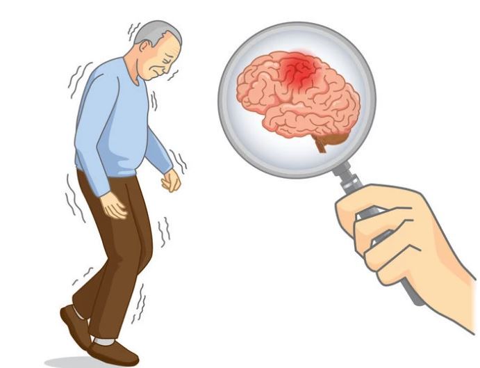 Bệnh nhồi máu não là một quá trình bệnh lý làm giảm lưu lượng tuần hoàn tới một vùng của não do hẹp, tắc mạch máu não hoặc do hạ huyết áp