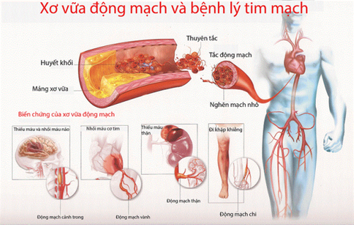 Xơ vữa động mạch gây nhiều biến chứng.