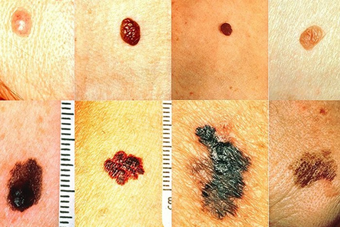 Các vết bất thường trên cơ thể có thể là dấu hiệu của ung thư da (theo anninhthudo.vn)