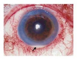 Biểu hiện của mắt khi bị viêm mống mắt.