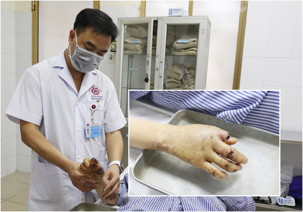 Bàn tay bệnh nhân được giữ gần nguyên vẹn sau khi bị cối xay thịt nghiền nát