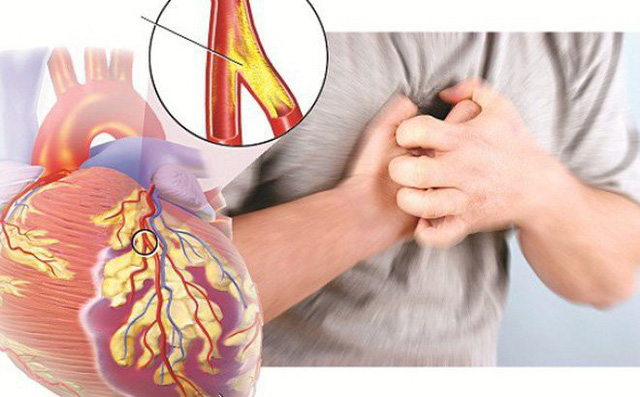 Người bệnh tim mạch nếu nhiễm Covid-19, tim phải làm việc quá mức để bảo đảm nguồn oxy tới các cơ quan, có khả năng làm bộc phát cơn đau tim hoặc đột quỵ.