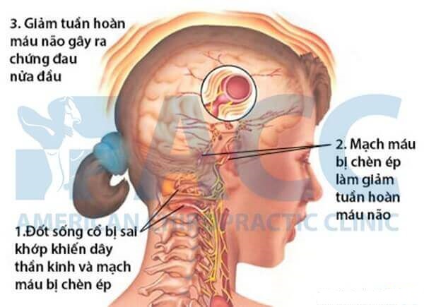 Giảm tuần hoàn máu não gây ra chứng đau nửa đầu.