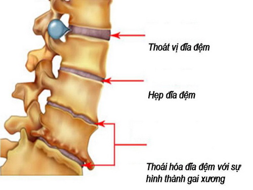 Khi bị các bệnh lý về cột sống, triệu chứng dễ nhận biết nhất là đau, mỏi lưng.