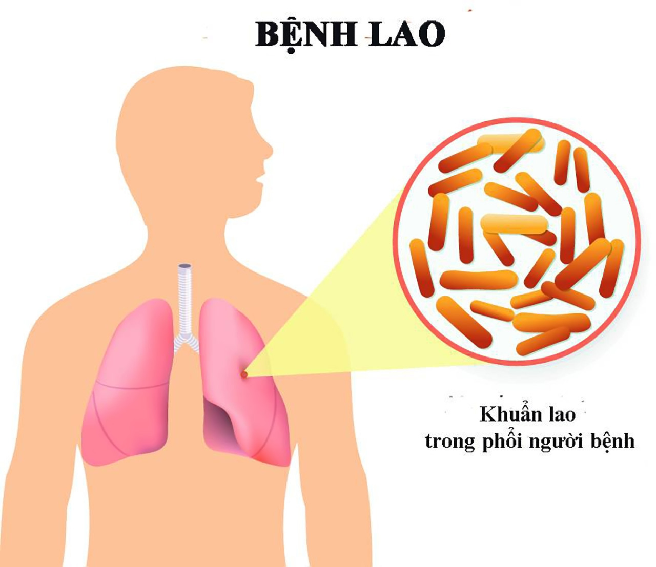 Bệnh lao là bệnh truyền nhiễm do vi khuẩn Mycobacterium tuberculosis gây ra.