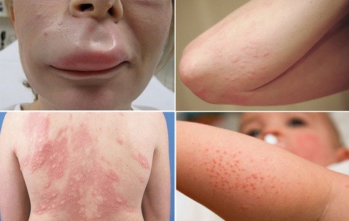  Biểu hiện của dị ứng thời tiết
