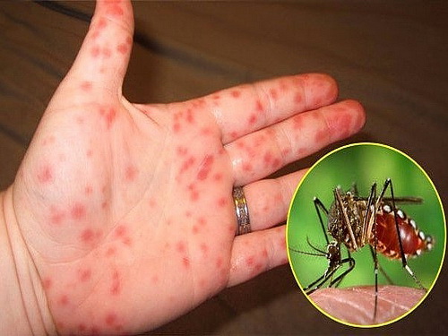 Thời tiết mùa hè thích hợp cho muỗi vằn sinh trưởng, gây bệnh sốt xuất huyết.