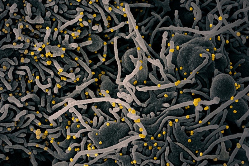 Một tế bào với các phân tử virus SARS-CoV-2 màu vàng. Ảnh: EPA-EFE