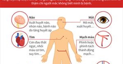 Ngày phòng chống tăng huyết áp Thế giới 17/5: Tăng huyết áp, mối đe dọa sức khỏe cộng đồng