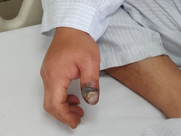 Một trường hợp bệnh nhân bị rắn cắn. (Ảnh: PV/Vietnam+)