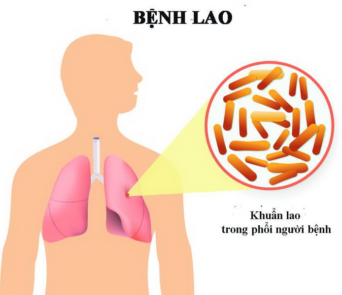 Lao phổi tái phát có thể xảy ra khi sức đề kháng suy yếu và thường xuyên tiếp xúc với người nhiễm lao.