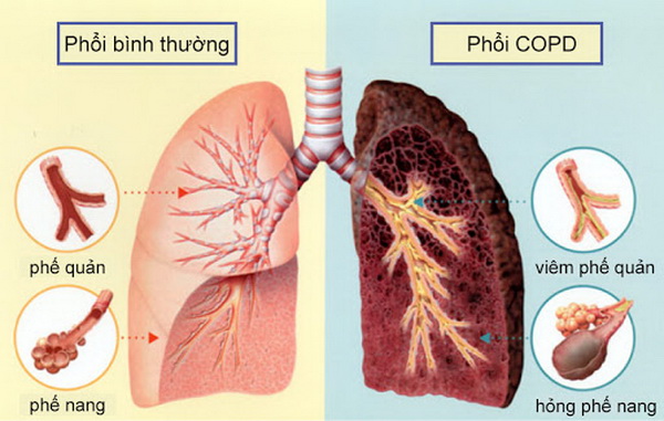 Lá dâu là vị thuốc trong bài “Tang hạnh thang gia giảm” trị bệnh COPD (còn gọi khái suyễn) giai đoạn đầu khi bệnh còn nhẹ.