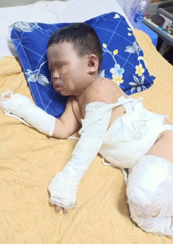 Vụ cháy khiến bé trai 3 tuổi, con chị Nam bị bỏng nặng.