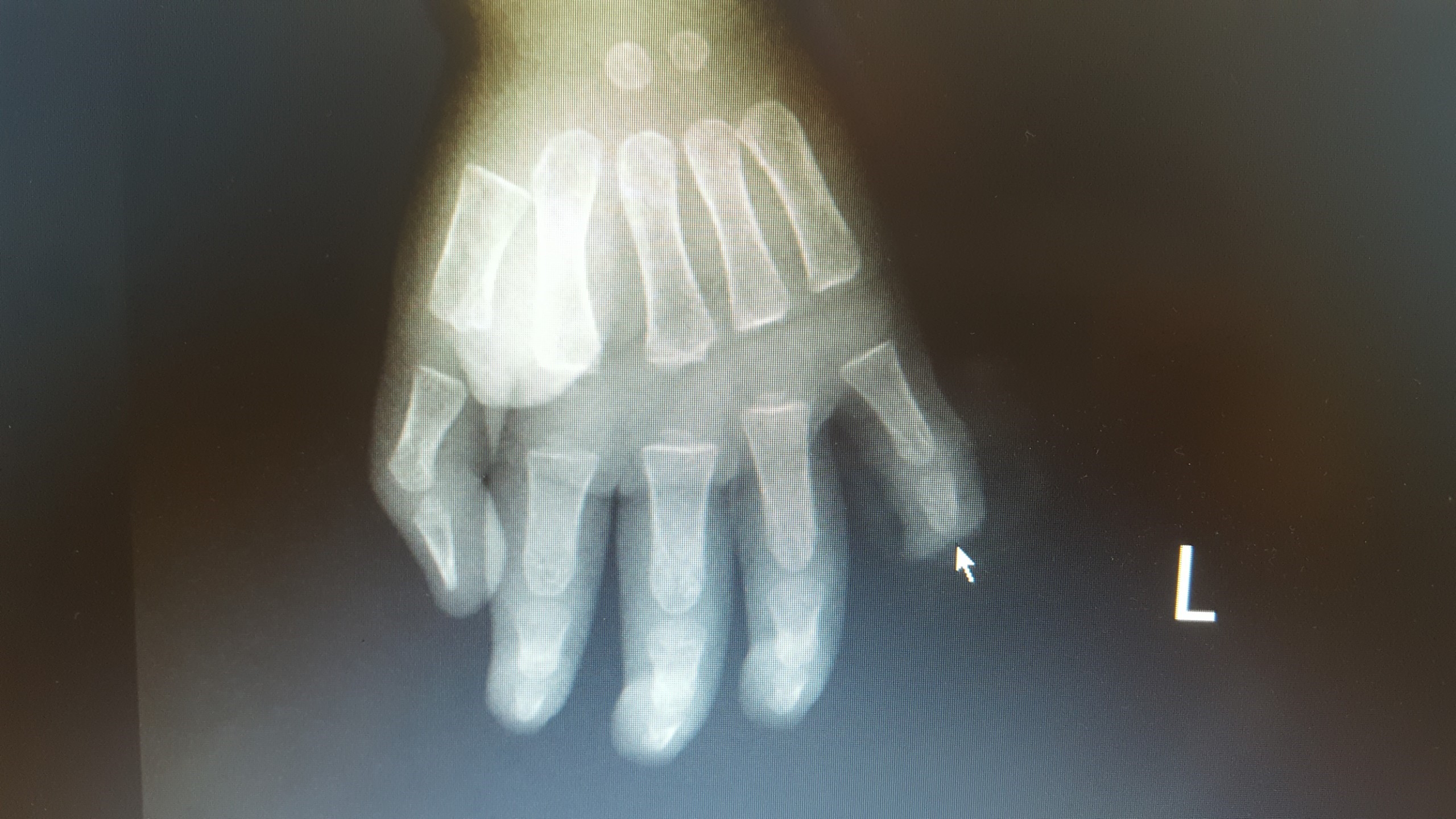 Phim chụp X-quang bàn tay trái của bệnh nhi.