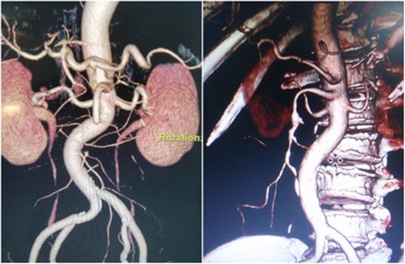 Hình ảnh chụp CLVT dựng hình đoạn mạch mạc treo bị tắc và được lấy huyết khối tái thông sau phẫu thuật