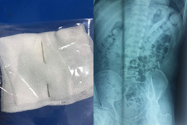 Chiếc kim được lấy ra (ảnh trái) và hình ảnh chiếc kim xuyên gan, dạ dày