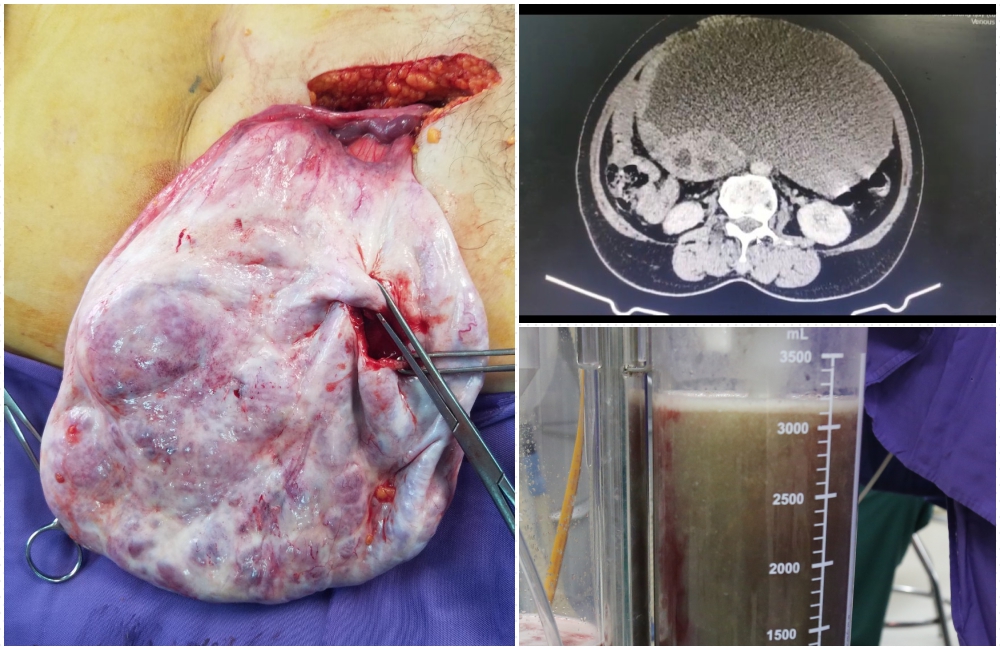 Hình ảnh khối u choán gần hết ổ bụng được lấy ra khỏi ổ bụng cùng gần 3200ml dịch nhầy.