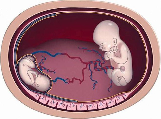 Trong các ca truyền máu song thai có sự thông nối mạch máu của hai thai với nhau