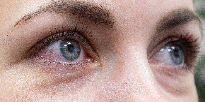 Bệnh mắt đỏ nên được xem như là một triệu chứng chính của COVID-19.
