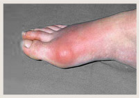 Cơn gút ban đầu thường ảnh hưởng đến khớp bàn ngón chân cái.