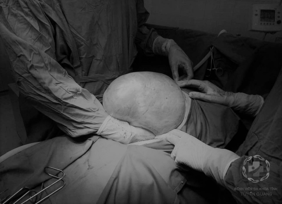 Ca phẫu thuật cắt bỏ khối u buồng trứng cho bệnh nhân