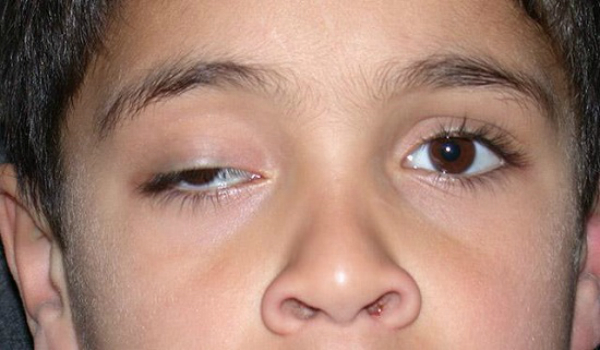 Một số biến chứng nguy hiểm do viêm xoang như viêm mắt làm cho trẻ sụp mi.