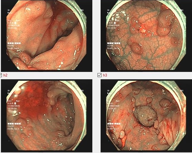 Hình ảnh nội soi đại trực tràng của bệnh nhân bị đa polyp đại tràng