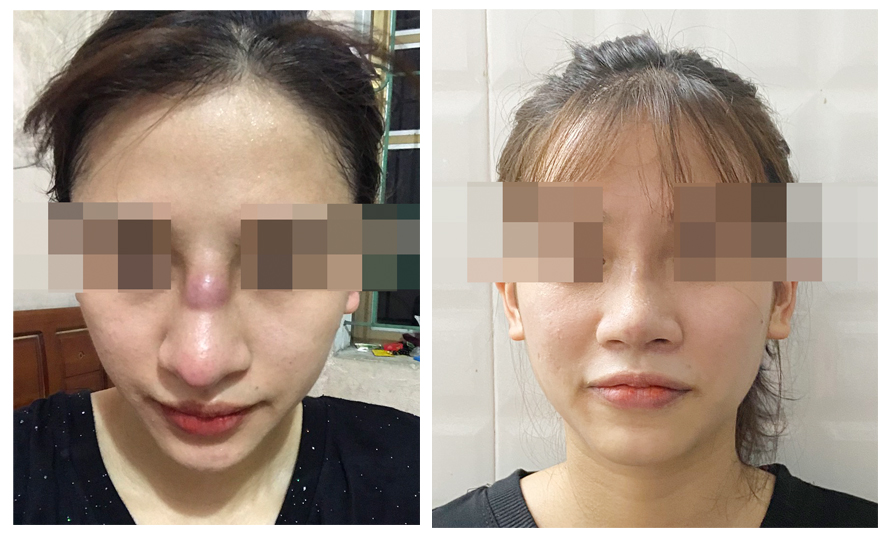Hình ảnh mũi người bệnh trước (Hình trái) và sau (Hình phải) khi điều trị tại Bệnh viện