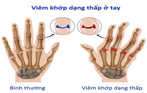 Biến dạng khớp bàn tay do viêm khớp dạng thấp (theo suckhoedoisong.vn)