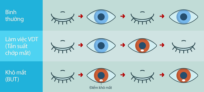 Cơ chế của mắt khi bình thường, làm việc trong môi trường văn phòng với thiết bị kỹ thuật số (VDT - Visual Display Terminal) và khi bị khô mắt, thời gian vỡ phim nước mắt (Break Up Tear - BUT ). Ảnh: Clinical Ophthalmology.
