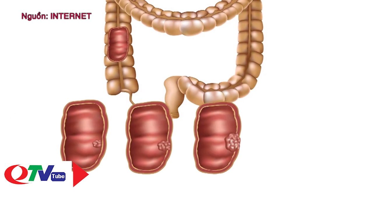 Tầm soát sớm và điều trị ung thư đại tràng