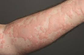 Các ban mề đay khi bị dị ứng thời tiết.