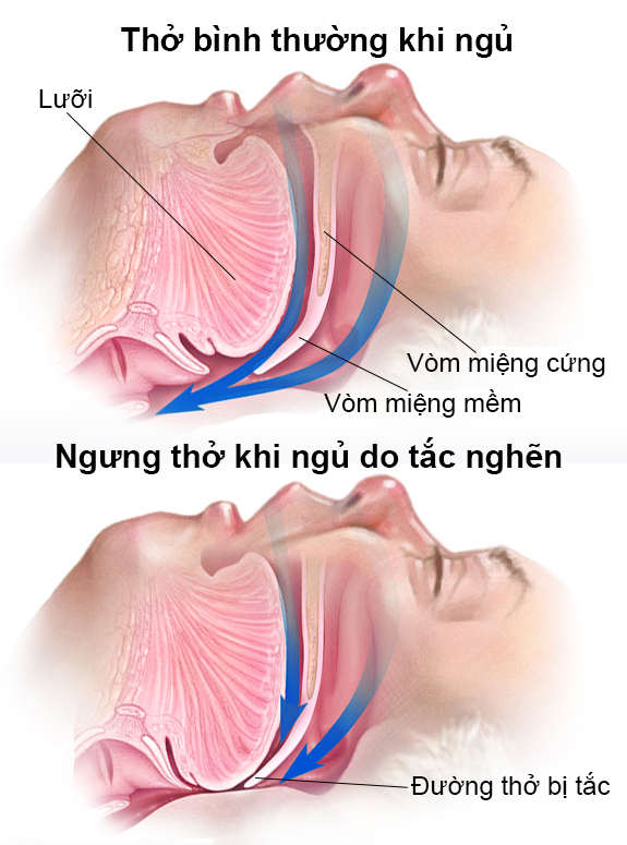 Một trong những nguyên nhân gây ngưng thở khi ngủ (theo vnexpress.net)