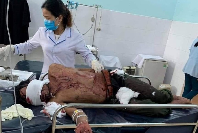 Ông Hồ Văn Hội - Người bị gấu rừng tấn công hiện đang được điều trị tại Bệnh viện Đa khoa Quảng Nam. Ảnh T. C