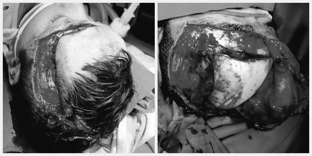  bệnh nhân nhập viện với chấn thương sọ não nặng, lóc da đầu phức tạp