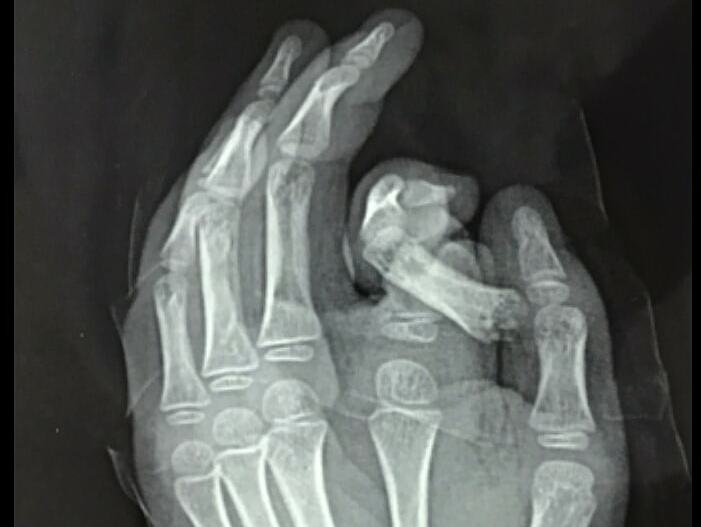 Phim chụp X-quang bàn tay bị tổn thương của trẻ. Ảnh: Bệnh viện cung cấp.