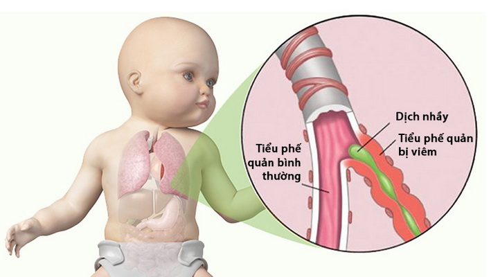 Viêm tiểu phế quản là bệnh thường gặp ở trẻ nhỏ.