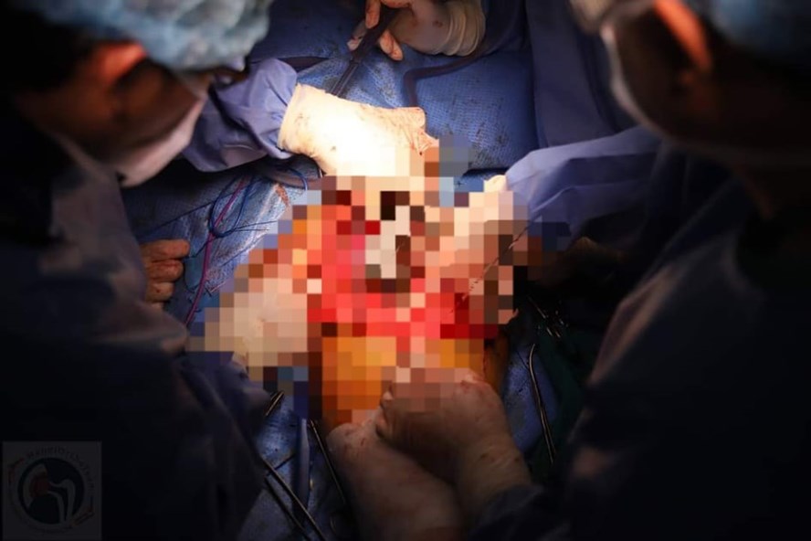 Các bác sĩ thực hiện ca phẫu thuật thay xương chậu bằng titan. Ảnh: BSCC