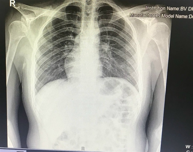 Hình ảnh phim chụp x-quang của bệnh nhân với phủ tạng nằm bên phải.
