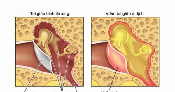 Viêm tai giữa là bệnh phổ biến, đặc biệt ở trẻ em dưới 3 tuổi.