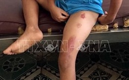 Điều tra vụ bé trai 6 tuổi bị cha dượng bạo hành ở Sóc Trăng