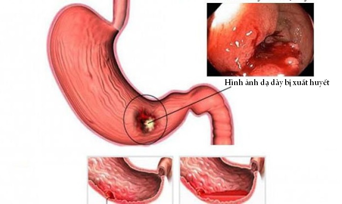 Xuất huyết dạ dày - một biến chứng cấp tính nguy hiểm.