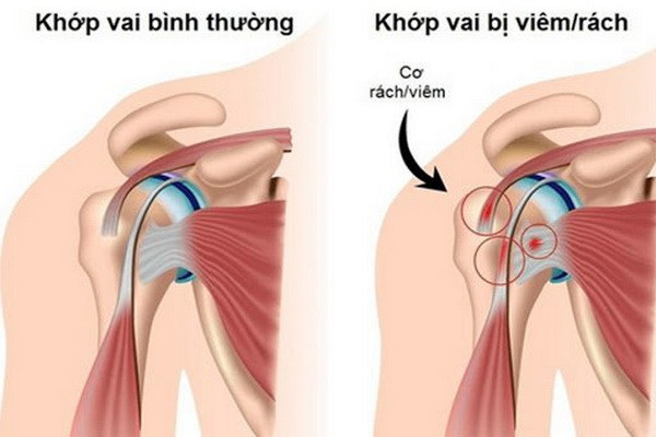 Khớp vai bị viêm gây giảm hoạt động, ảnh hưởng đến chất lượng cuộc sống.