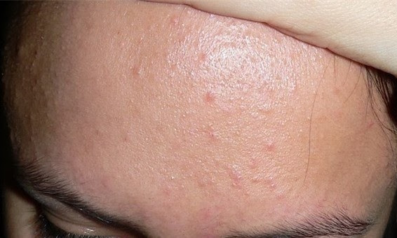 Nguyên tắc điều trị mụn ẩn bạn cần nhớ