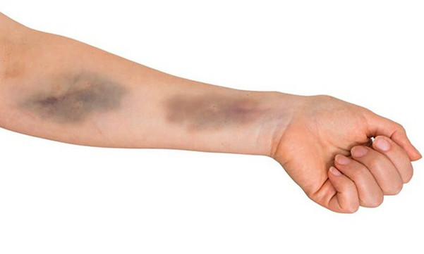 Hai màu sắc bất thường trên da cảnh báo bệnh gan nguy hiểm